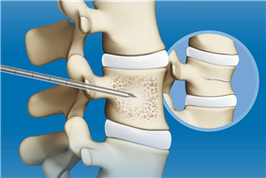 椎體成形術(shù)輔助器械彩頁(yè)